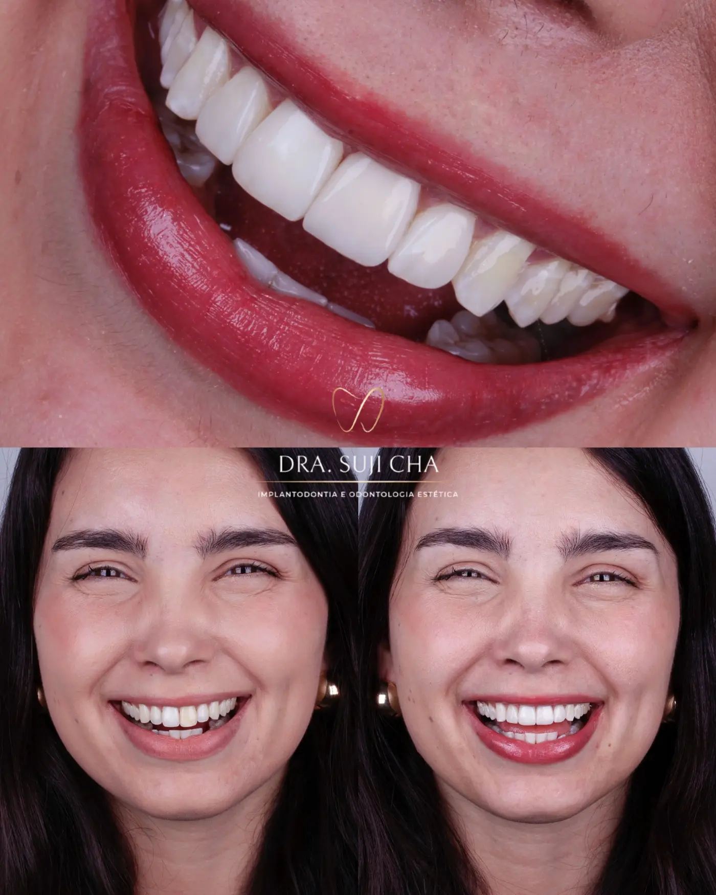 Antes e depois de caso clínico de estética dental