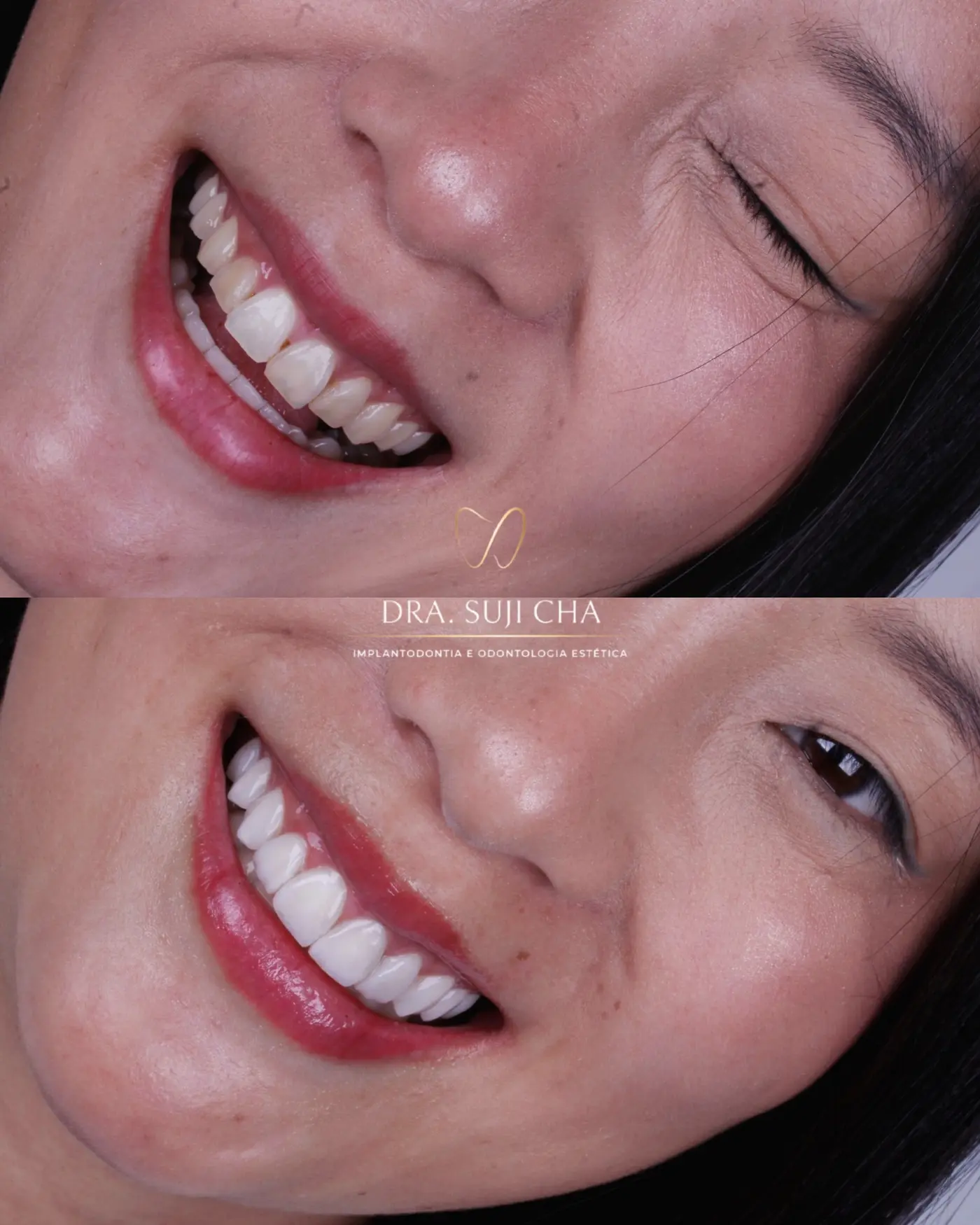 Antes e depois de caso clínico de estética dental
