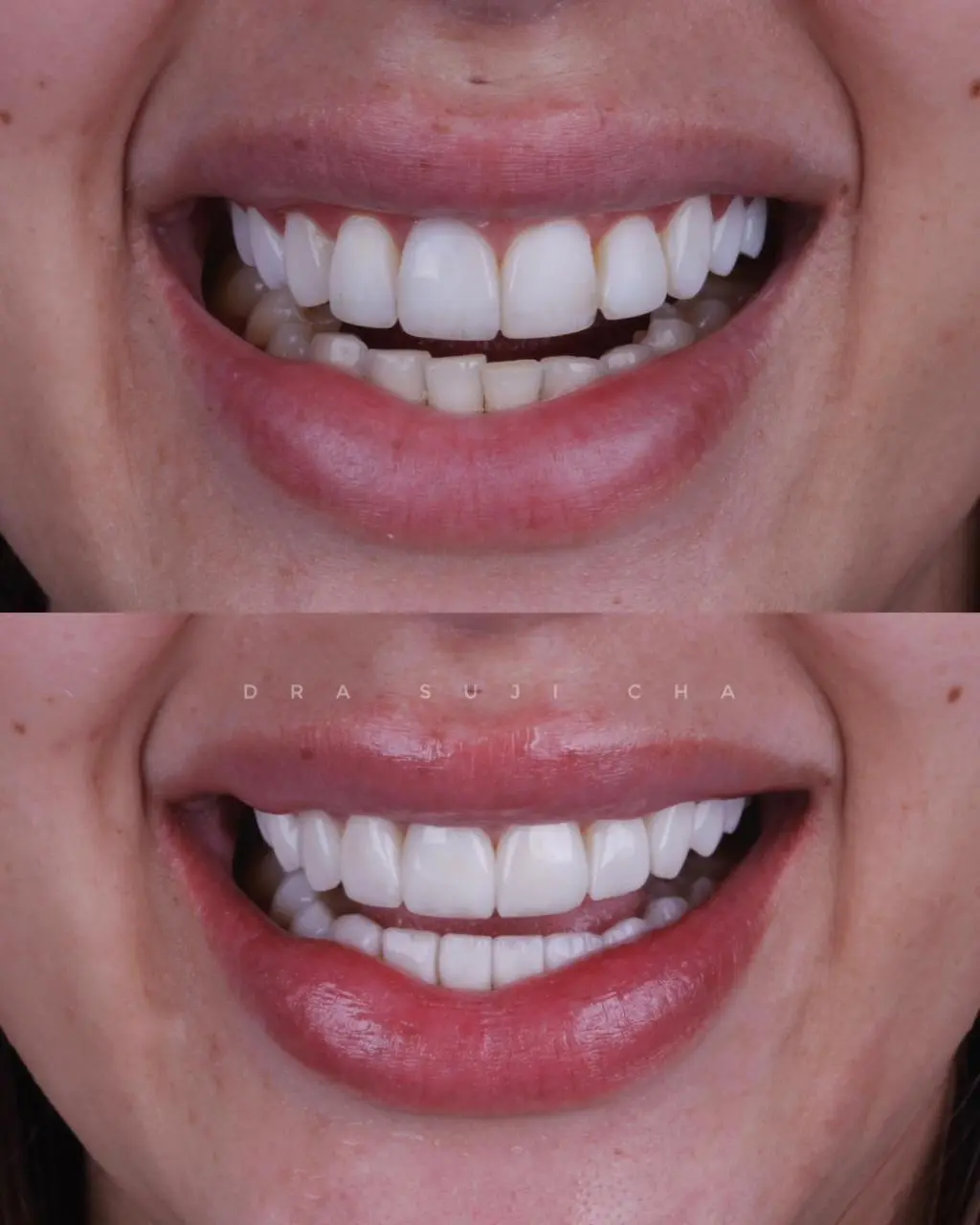 Antes e depois de caso clínico de estética dental
